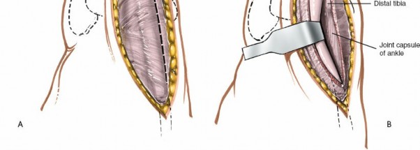 Illustration 13 for Optimized Approaches to the Dorsum of the Foot & Ankle