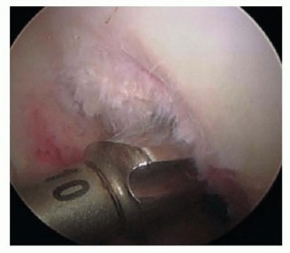 Illustration 12 for Posterior Cruciate Ligament Surgery: Regain Knee Strength & Stability