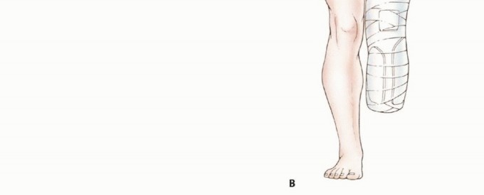 Illustration 19 for Below-Knee Amputation: Maximize Your Below-Knee Recovery & Function