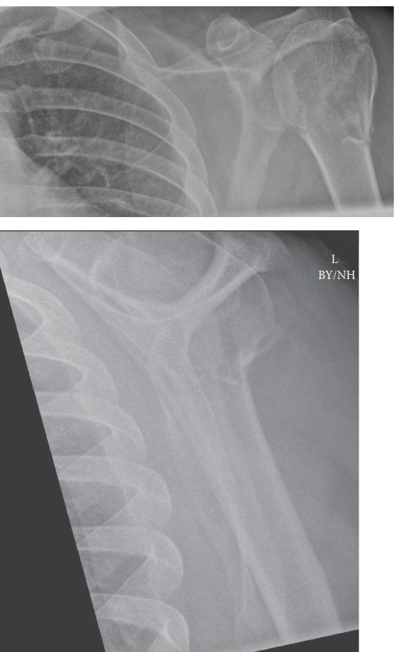 Proximal Humerus Fractures: Epidemiology, Classification, Anatomy & Management
