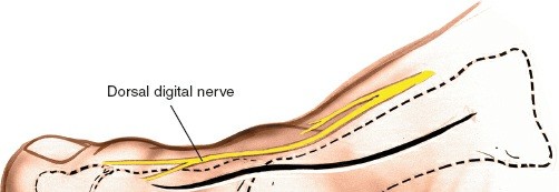 Mastering Dorsomedial Approaches to the Metatarsophalangeal Joint of the Great Toe