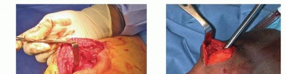 Illustration 23 for Advanced Nailing of the Mature Tibia: Overcoming Complexities