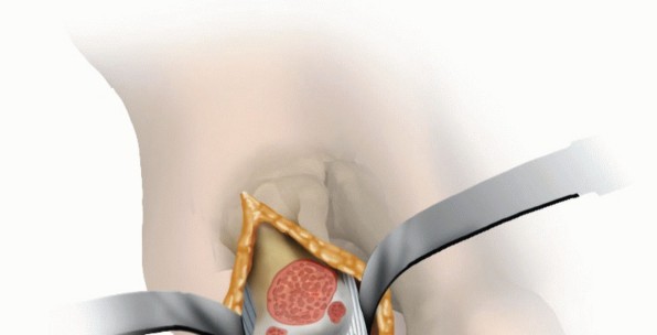 Illustration 9 for Mastering Extensive Plantar Release for Hallux Rigidus