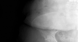 Illustration 14 for Mastering Direct Anterior Approach Hip Arthroplasty Without a Traction Table