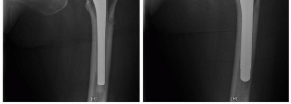 Illustration 2 for Extended Trochanteric Osteotomy: How et al Extended Revision THA Solutions