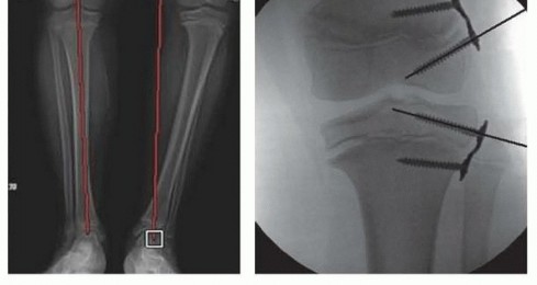 Illustration 18 for Optimizing Growth to Correct Pediatric Limb Deformities