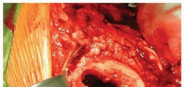 Illustration 8 for Why Polished Tapered Cemented Stems Excel in Hip Replacement