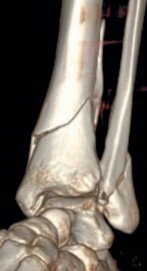 Illustration 15 for Decoding Pilon Fractures: Anterolateral and Medial Fragments Revealed