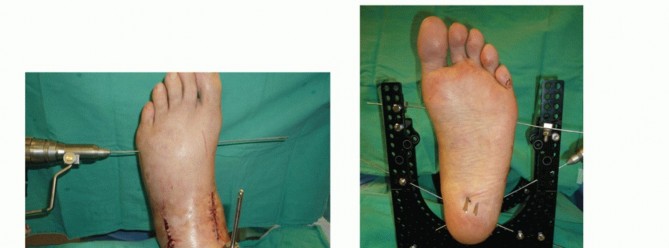 Illustration 43 for Optimize Pain Management with Proximal Ring Block for Ankle Arthrodesis