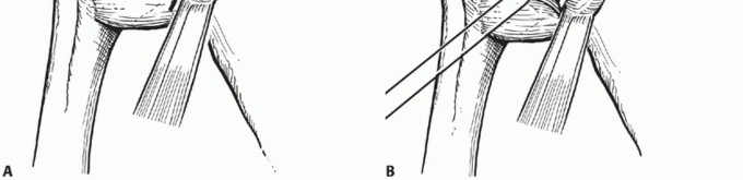 Illustration 16 for Latarjet for Instability: Bone Loss Solutions, Per Burkhart SS, Lo