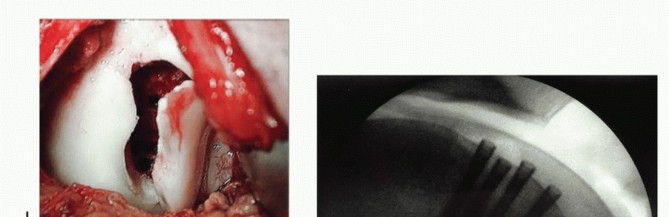 Illustration 32 for Dissecans of the Knee: What's the Difference – OCD vs. AVN?