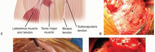 Illustration 23 for Restore Shoulder Function with Latissimus Dorsi Tendon Transfer