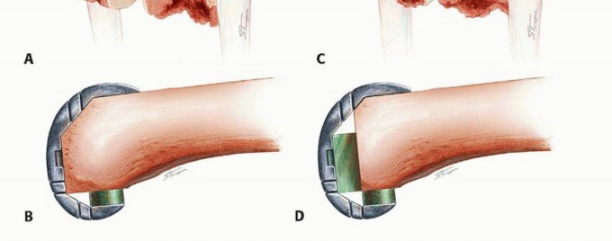Illustration 3 for Optimizing Revision Femoral Component with Distal Femoral Bone Loss