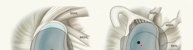كتف الرامي: فهم شامل، أسباب، أعراض، وعلاجات متقدمة لعودة الرياضيين بقوة