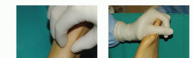 Illustration 3 for Foot Drop Surgery: How a Pin or Drill Elevates Tendon Transfer