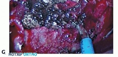 Illustration 16 for Anterior Interbody Arthrodesis for Scoliosis: What You Need to Know