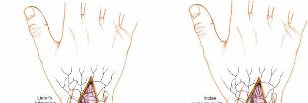 Illustration 14 for Dorsal Wrist Approach: Expert Access to the Column of the Distal Radius
