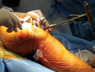 Illustration 9 for Minimally Invasive Subvastus: The Best Path to Quicker TKA Recovery