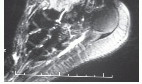 Illustration 12 for Unlock Stability: Medullary Nail Fixation for Tibiotalocalcaneal Arthrodesis