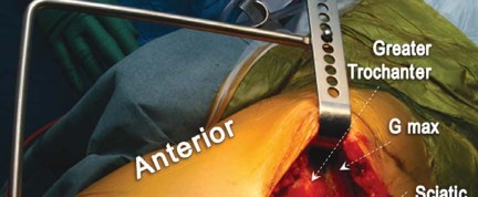 Illustration 27 for Birmingham Hip Resurfacing Designer's Technique for Active Lives