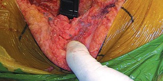 Illustration 40 for Hinged Total Knee: The Salvage Solution for Challenging Cases