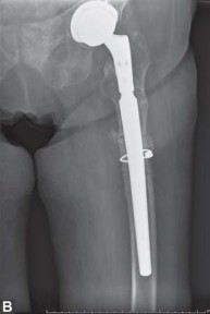 Illustration 14 for THA for patients with proximal femoral deformity: Practical solutions