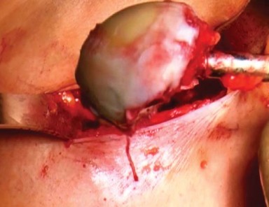 Illustration 11 for Mastering the Anterolateral Approach in Minimally Invasive Hip Replacement