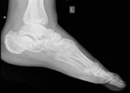 كسر الكعب: دليل شامل لإدارة وعلاج كسور عظم الكعب بعد السقوط من ارتفاع مع الأستاذ الدكتور محمد هطيف