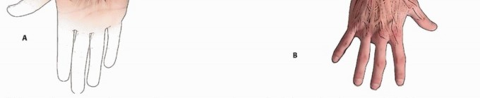 Illustration 4 for Optimal ORIF for Diaphyseal Forearm Fractures: Your Guide