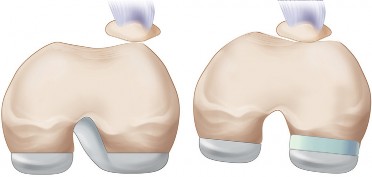 Illustration 23 for Understand Augments: The Role of Metal Augments in Arthroplasty