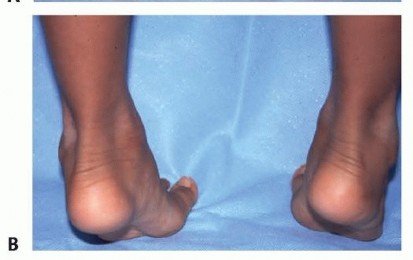 Illustration 4 for Calcaneal Lengthening Osteotomy: Correcting Hindfoot Valgus