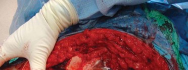 Illustration 144 for Successful Total Hip Replacement in Developmental Dysplasia