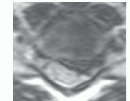 Illustration 6 for How ACDF Clears Your Posterior Disc Space for Lasting Relief