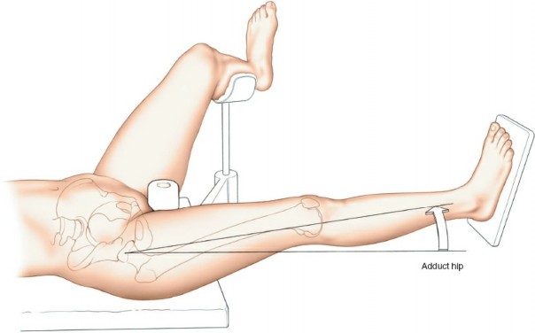 Illustration 59 for Optimal Femoral Approaches: Mastering the Lateral Intermuscular Septum