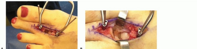 Illustration 21 for Toe Deformity Pain? Rebalance Flexor to Extensor for Relief
