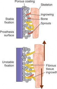 Illustration 45 for Mastering Hip Arthroplasty: Its Evolution and Design Unveiled