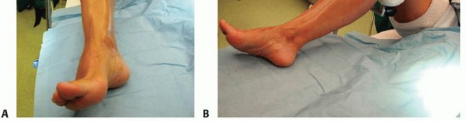 Illustration 13 for Medial Ankle Instability: Find Relief with Reconstruction