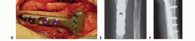Illustration 26 for Precision Correction for Distal Radius Malunion