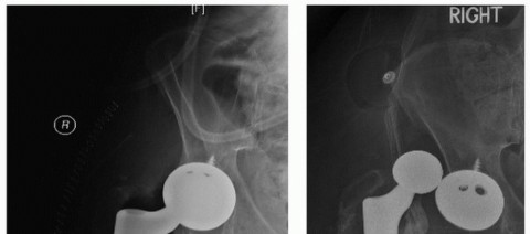 Illustration 21 for Extended Trochanteric Osteotomy: How et al Extended Revision THA Solutions