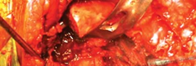 Illustration 12 for Unlock Movement: Arthroplasty for Bony Ankylosis Solutions