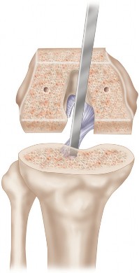 Illustration 9 for Posterior Cruciate Ligament-Retaining TKA: Navigating Pitfalls