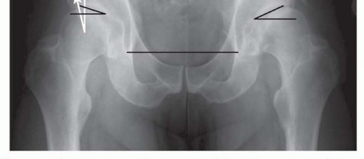 Illustration 8 for Anterior FAI Relief: Mini-Open Anterior Approach Explained