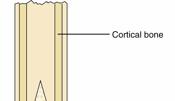رسم توضيحي طبي لإجراء تغطية الجذع للمبتورين الأحداث لمنع النمو الزائد للعظم