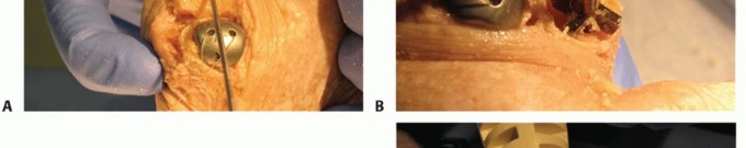 Illustration 67 for End Articular Cartilage Loss: Arthrosurface HemiCAP Resurfacing
