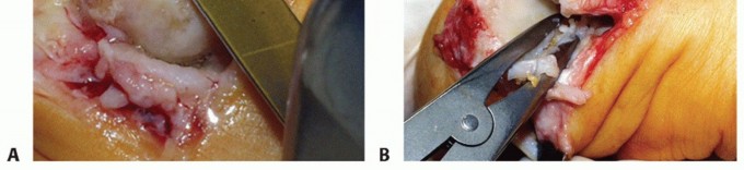 Illustration 6 for Mastering Extensive Plantar Release for Hallux Rigidus