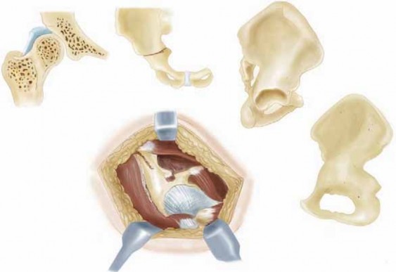 Pelvis Chiari Medial Osteotomy: Salvaging Dysplastic Hips