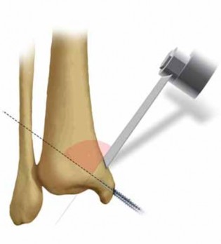 Illustration 13 for Talar Neck Fracture Treatment: Optimizing Recovery with ORIF