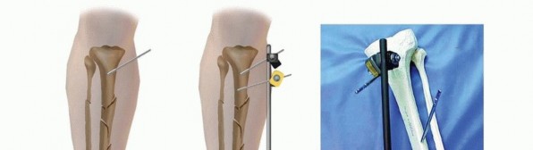 Illustration 26 for Tibia External Fixation: See How Pins Are Placed for Healing