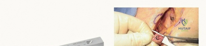 اكتشف: كسر هولشتاين-لويس.. دليل التعافي الأمثل!