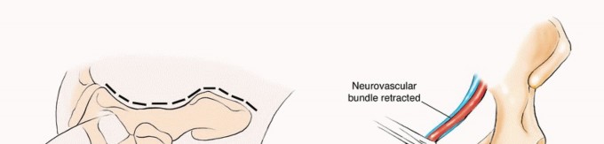 Illustration 23 for Pelvic Metastasis Surgery: A Component of the Utilitarian Approach